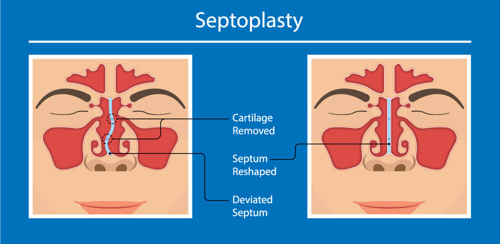 nasal-blockage-nose-conditions-and-procedures-worcestershire-ear